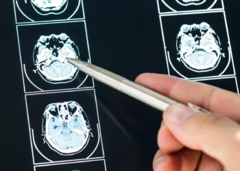 Ecco come il Long Covid cambia il cervello con meccanismi tipici dell’Alzheimer